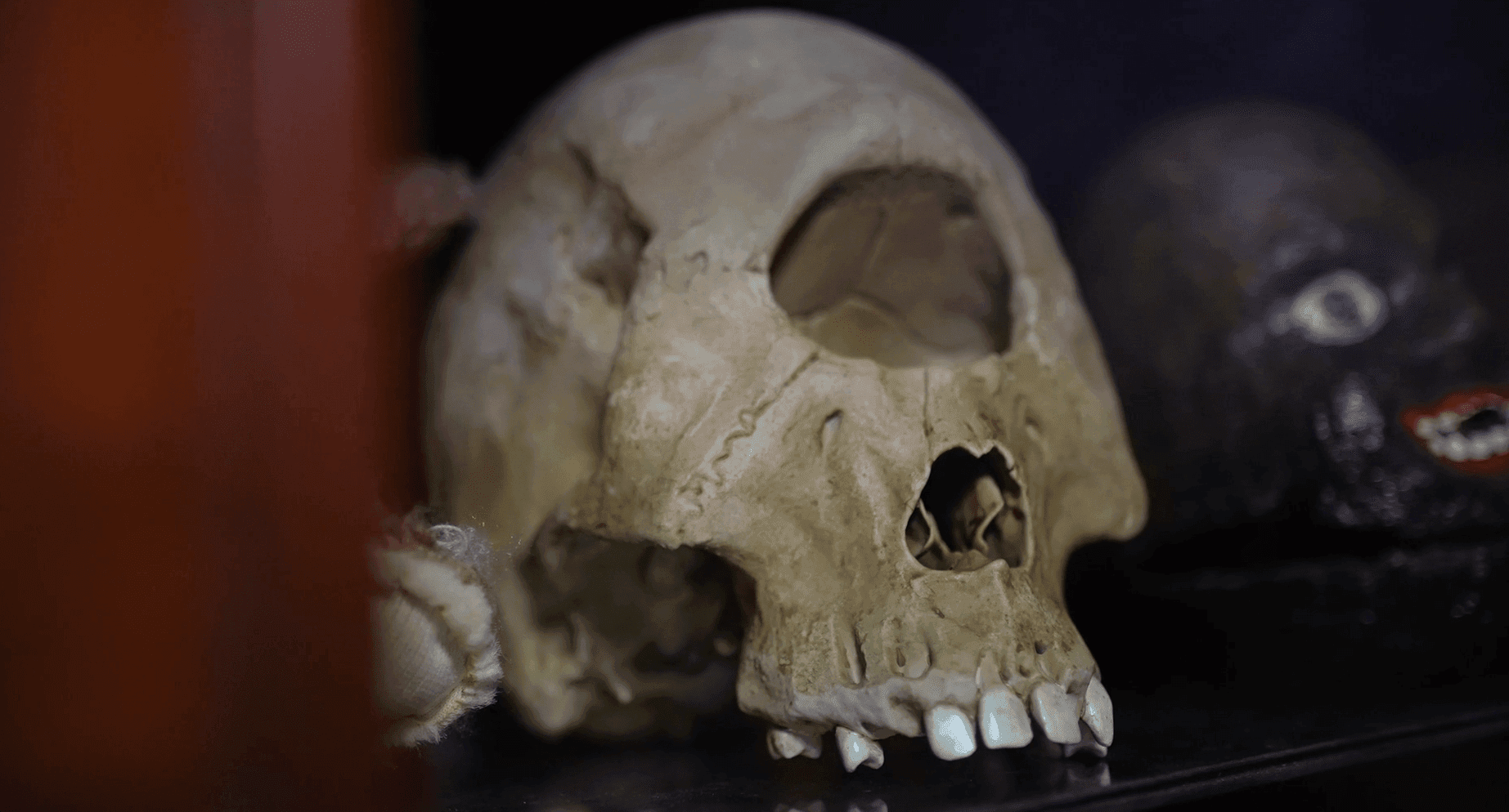 Close-up of a deformed or pathological human skull on display, showing large, irregular eye sockets, a missing nasal cavity, and prominent teeth, possibly part of a medical or anatomical collection in a museum setting.